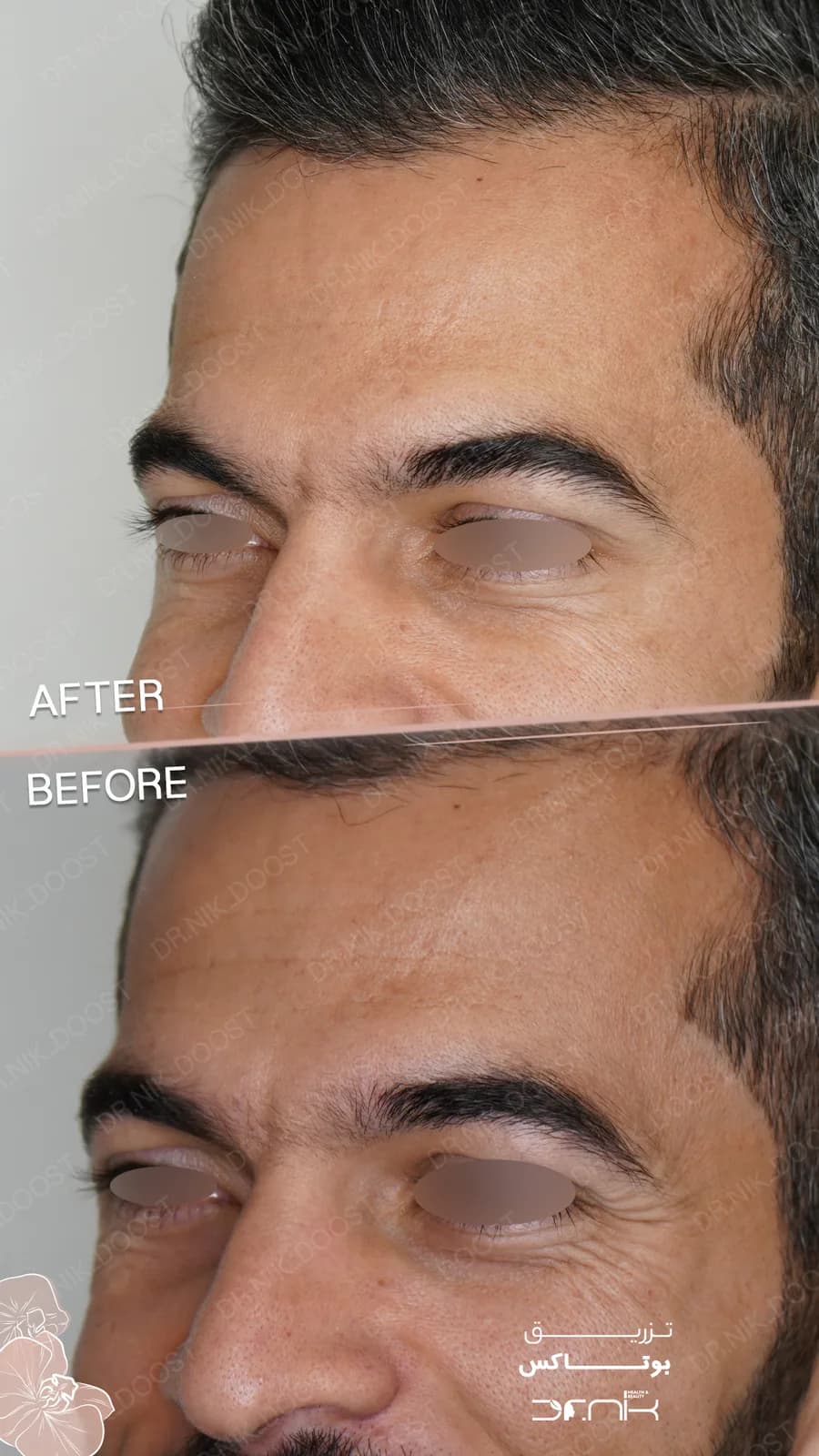 botox gallery