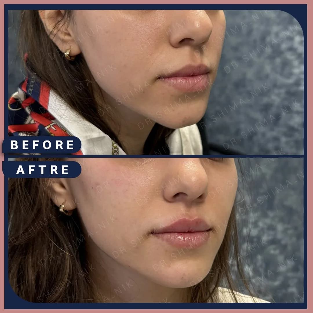 chin-before-after gallery