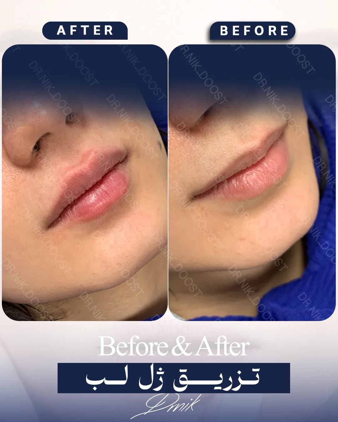 lip gallery