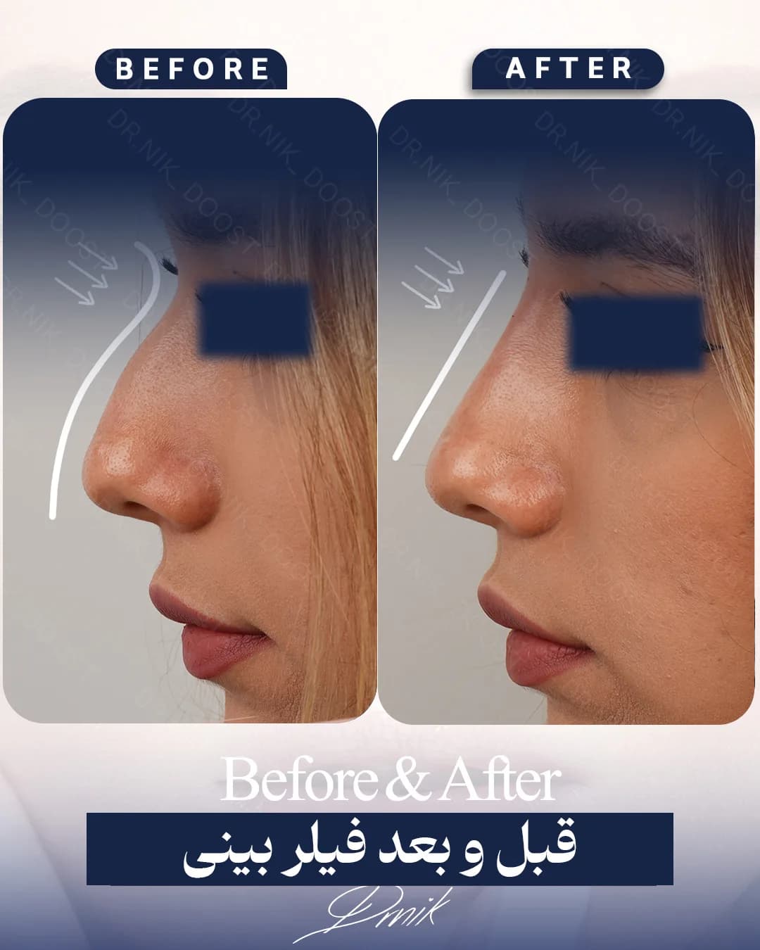 nose gallery